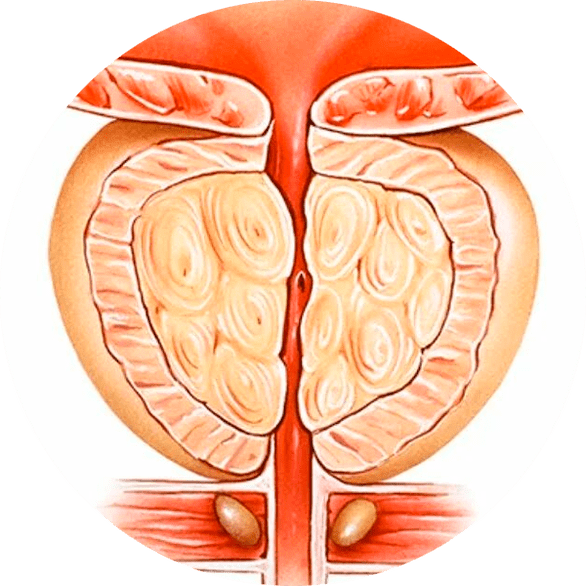 Gevolgen van onbehandelde prostatitis