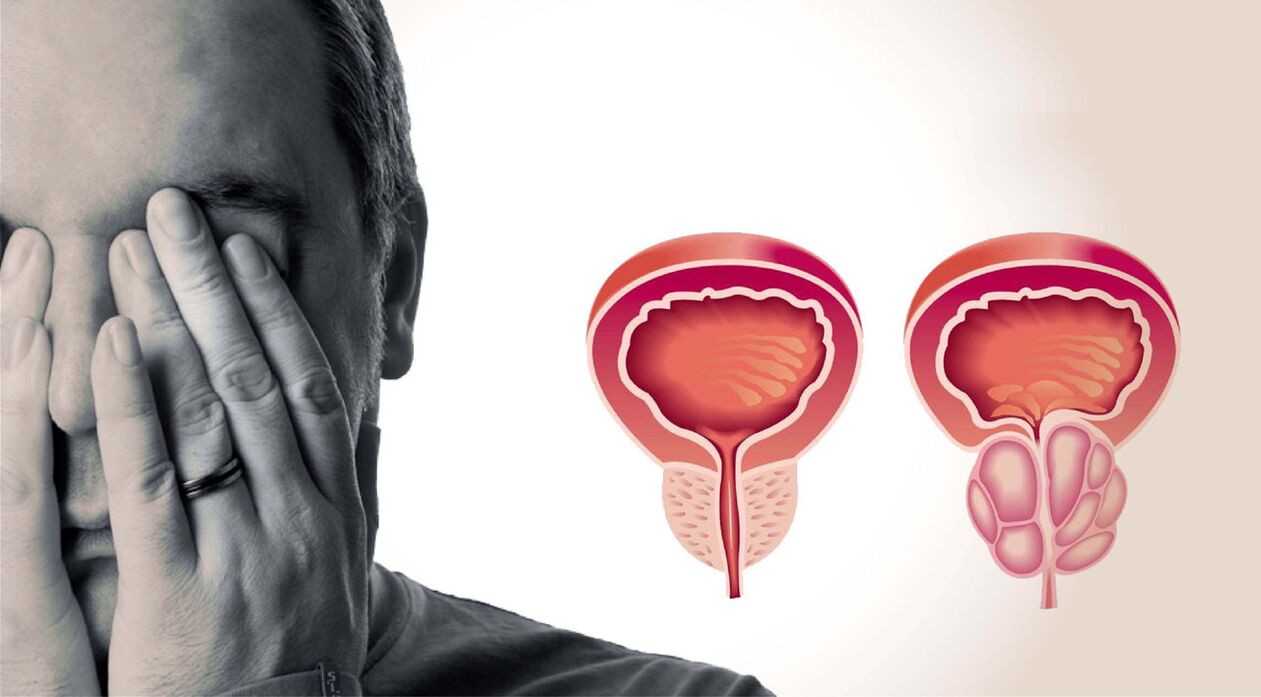 chronische prostatitis bij mannen