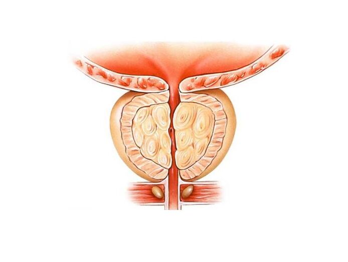 behandeling van prostatitis met folkremedies