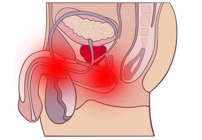 behandelmethoden voor prostatitis