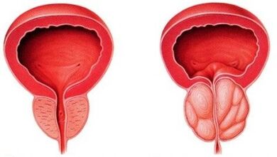gezonde en ontstoken prostaat met prostatitis